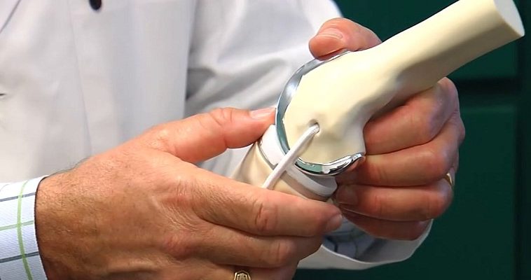 What Are The Various Types Of Knee Replacement Surgery Conducted In India?